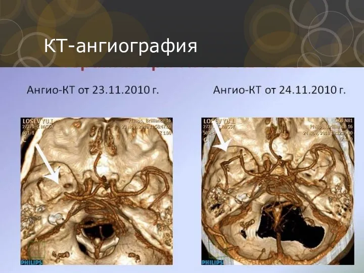 КТ-ангиография