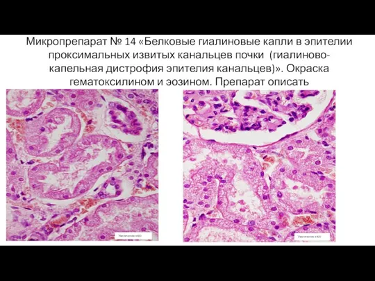 Микропрепарат № 14 «Белковые гиалиновые капли в эпителии проксимальных извитых