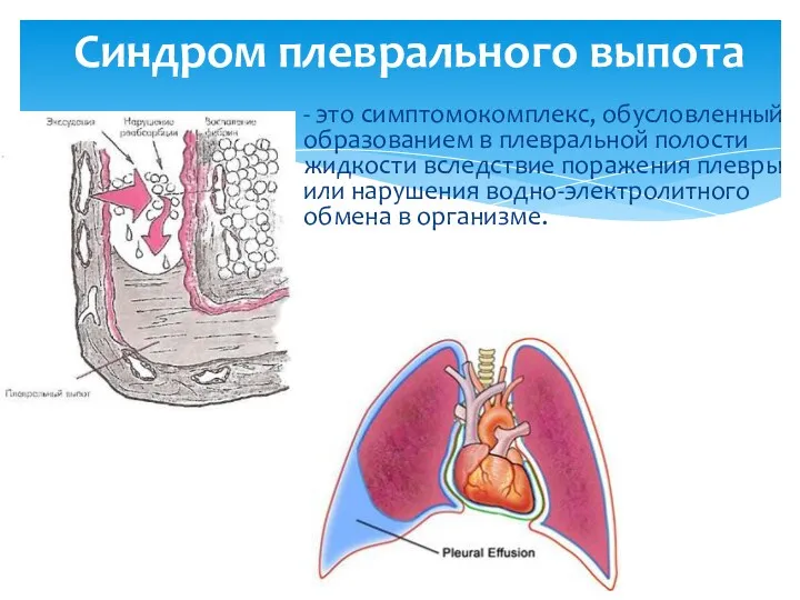 - это симптомокомплекс, обусловленный образованием в плевральной полости жидкости вследствие