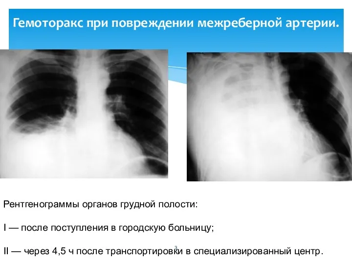 Гемоторакс при повреждении межреберной артерии. Рентгенограммы органов грудной полости: I