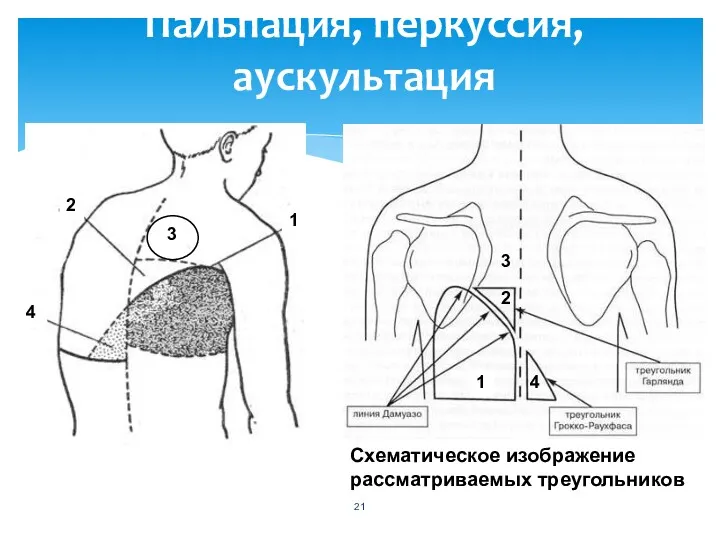 Пальпация, перкуссия, аускультация Схематическое изображение рассматриваемых треугольников 2 3 4 1 1 2 3 4