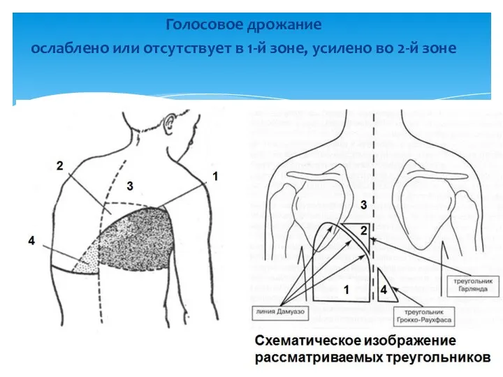 Голосовое дрожание ослаблено или отсутствует в 1-й зоне, усилено во 2-й зоне