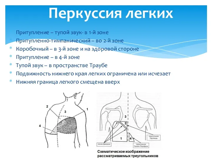 Притупление – тупой звук- в 1-й зоне Притупленно-тимпанический – во