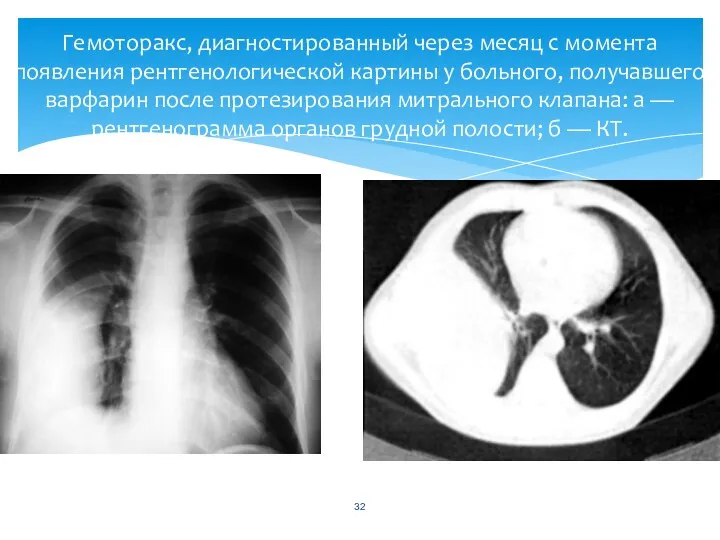 Гемоторакс, диагностированный через месяц с момента появления рентгенологической картины у