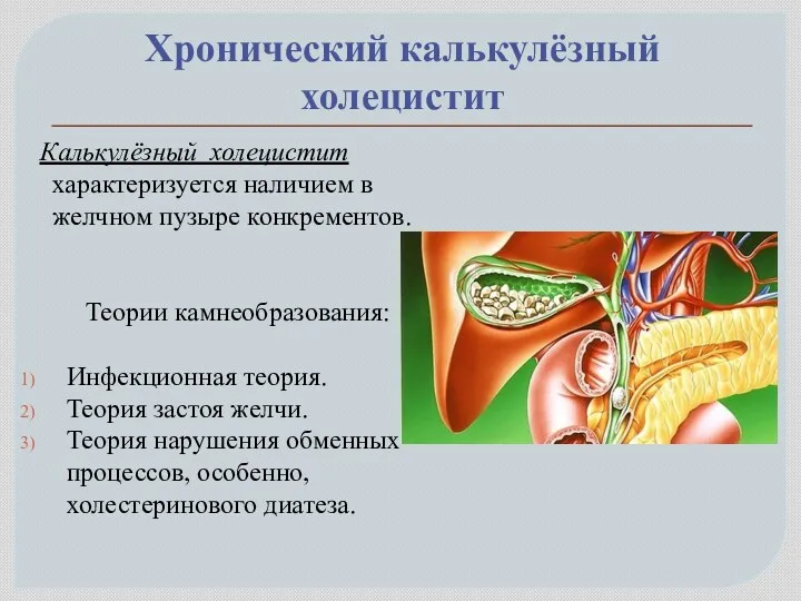 Хронический калькулёзный холецистит Калькулёзный холецистит характеризуется наличием в желчном пузыре