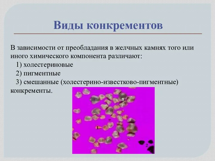 Виды конкрементов В зависимости от преобладания в желчных камнях того