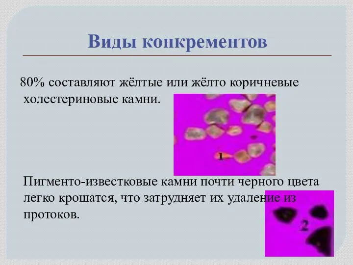 Виды конкрементов 80% составляют жёлтые или жёлто коричневые холестериновые камни.