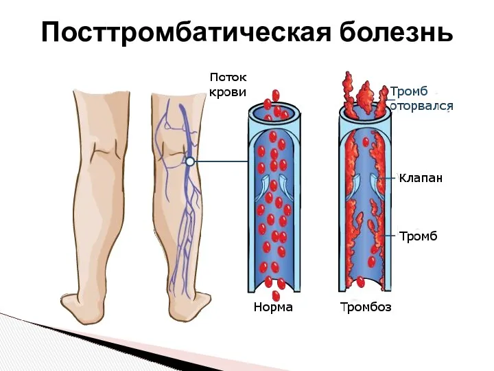 Посттромбатическая болезнь