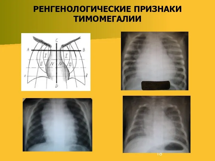 РЕНГЕНОЛОГИЧЕСКИЕ ПРИЗНАКИ ТИМОМЕГАЛИИ