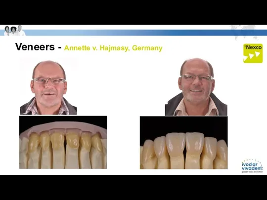 Veneers - Annette v. Hajmasy, Germany