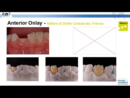 Anterior Onlay - Hélène & Didier Creszenzo, France