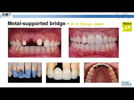 Metal-supported bridge - Dr. A. Shinya, Japan