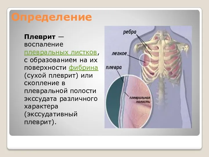 Определение Плеврит — воспаление плевральных листков, с образованием на их