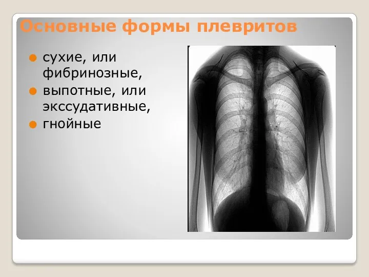 Основные формы плевритов сухие, или фибринозные, выпотные, или экссудативные, гнойные