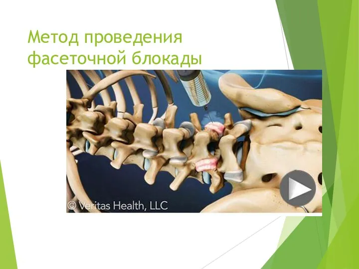 Метод проведения фасеточной блокады