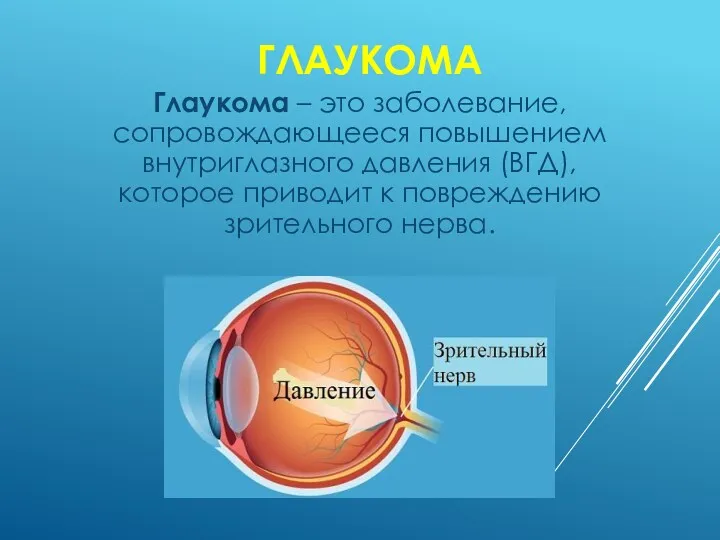 ГЛАУКОМА Глаукома – это заболевание, сопровождающееся повышением внутриглазного давления (ВГД), которое приводит к повреждению зрительного нерва.