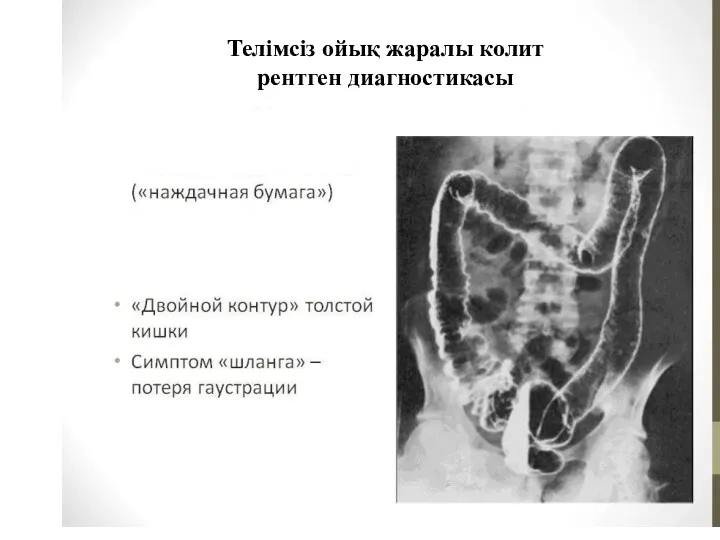 Телімсіз ойық жаралы колит рентген диагностикасы