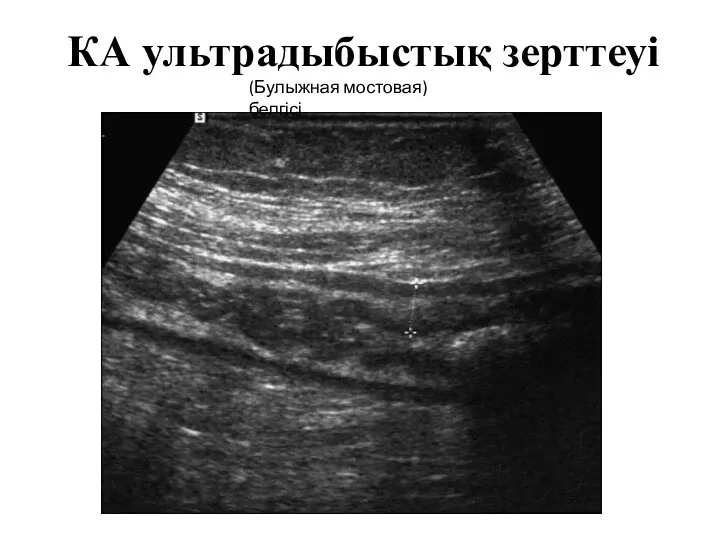 КА ультрадыбыстық зерттеуі (Булыжная мостовая) белгісі