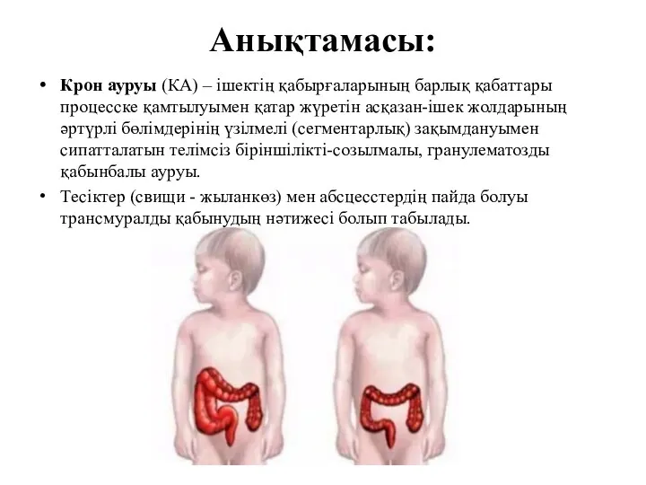 Анықтамасы: Крон ауруы (КА) – ішектің қабырғаларының барлық қабаттары процесске