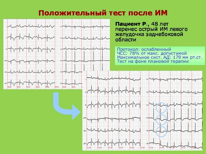 Положительный тест после ИМ Пациент Р., 48 лет перенес острый