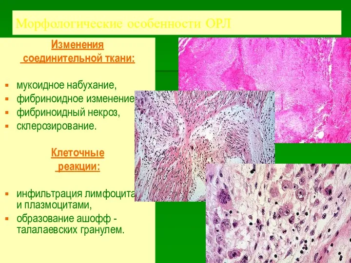 Морфологические особенности ОРЛ Изменения соединительной ткани: мукоидное набухание, фибриноидное изменение,