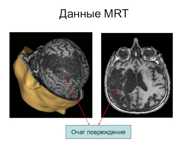 Данные MRT Очаг повреждения