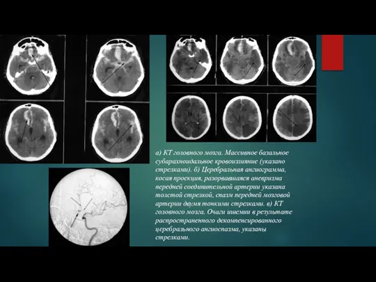 a) КТ головного мозга. Массивное базальное субарахноидальное кровоизлияние (указано стрелками).