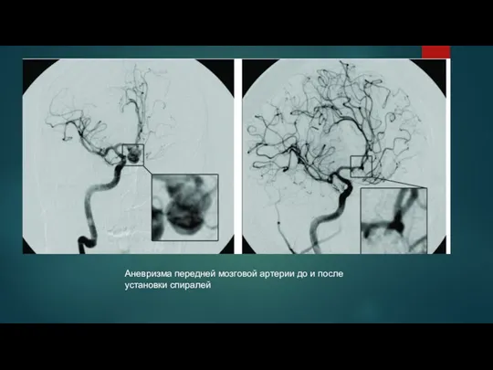Аневризма передней мозговой артерии до и после установки спиралей