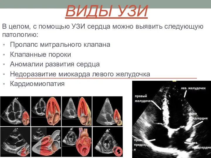 ВИДЫ УЗИ В целом, с помощью УЗИ сердца можно выявить