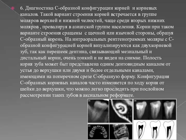 6. Диагностика С-образной конфигурации корней и корневых каналов. Такой вариант