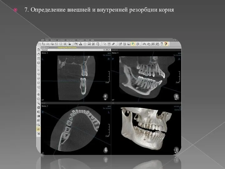 7. Определение внешней и внутренней резорбции корня