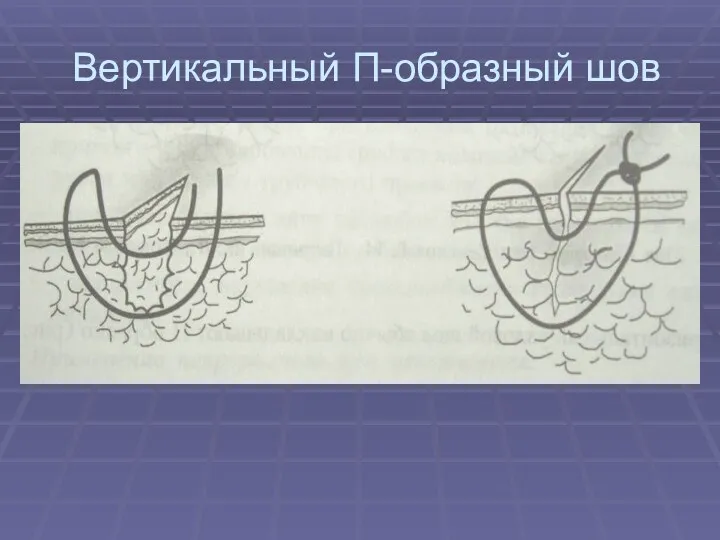 Вертикальный П-образный шов