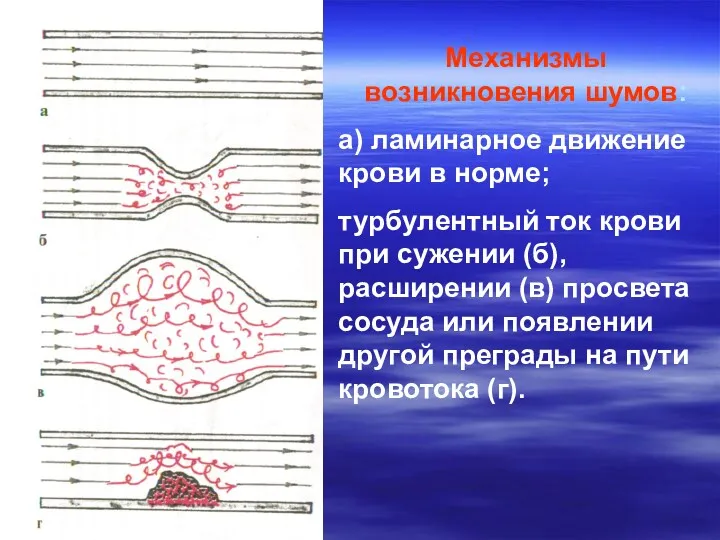 Механизмы возникновения шумов: а) ламинарное движение крови в норме; турбулентный