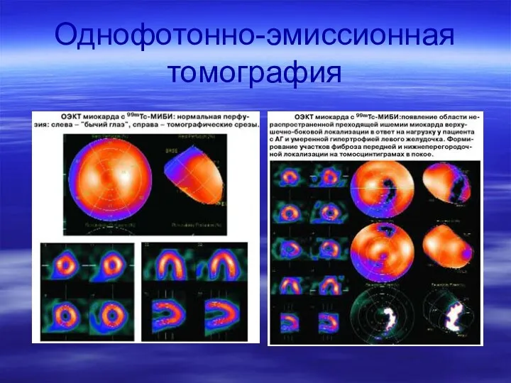 Однофотонно-эмиссионная томография