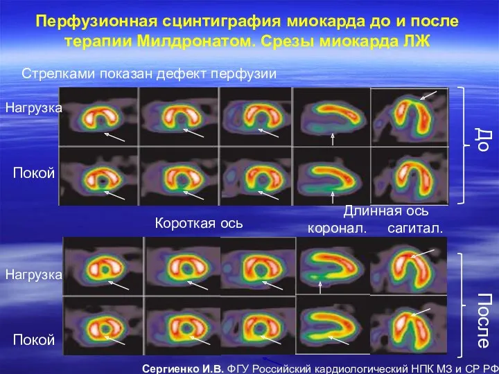 Перфузионная сцинтиграфия миокарда до и после терапии Милдронатом. Срезы миокарда