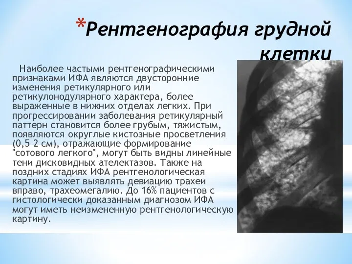 Рентгенография грудной клетки Наиболее частыми рентгенографическими признаками ИФА являются двусторонние изменения ретикулярного или