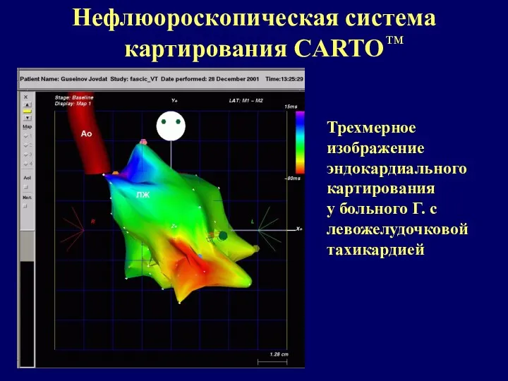 Нефлюороскопическая система картирования CARTO тм Трехмерное изображение эндокардиального картирования у больного Г. с левожелудочковой тахикардией