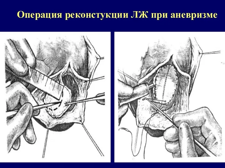 Операция реконстукции ЛЖ при аневризме