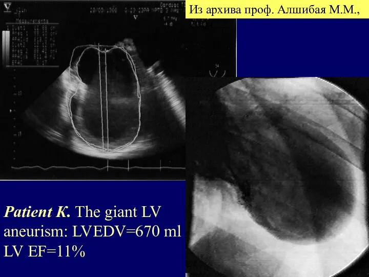 Patient К. The giant LV aneurism: LVEDV=670 ml LV EF=11% Из архива проф. Алшибая М.М., 2004