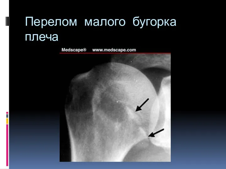 Перелом малого бугорка плеча