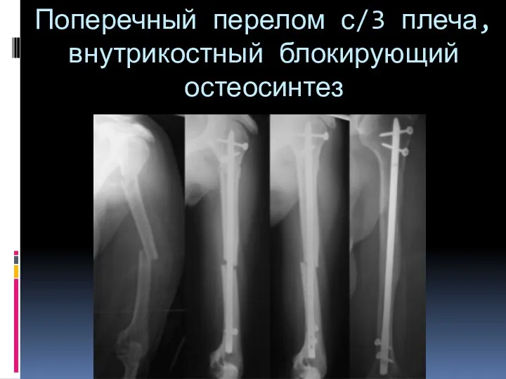 Поперечный перелом с/3 плеча, внутрикостный блокирующий остеосинтез