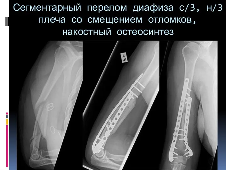 Сегментарный перелом диафиза с/3, н/3 плеча со смещением отломков, накостный остеосинтез