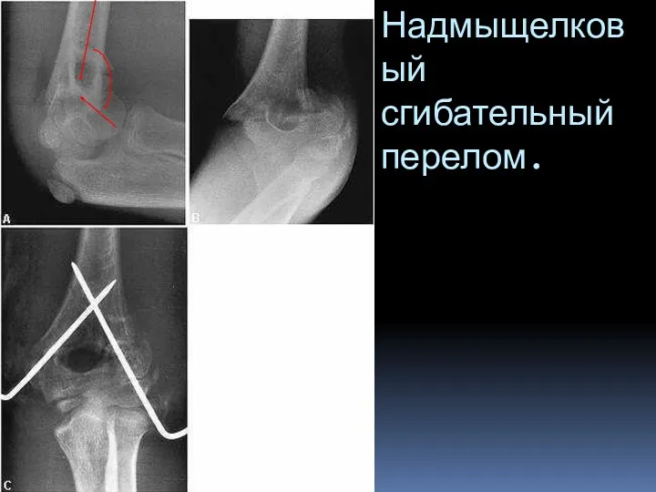 Надмыщелковый сгибательный перелом.