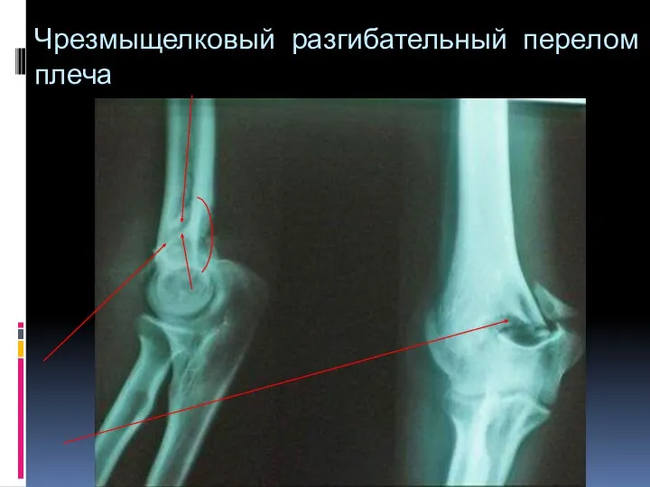 Чрезмыщелковый разгибательный перелом плеча