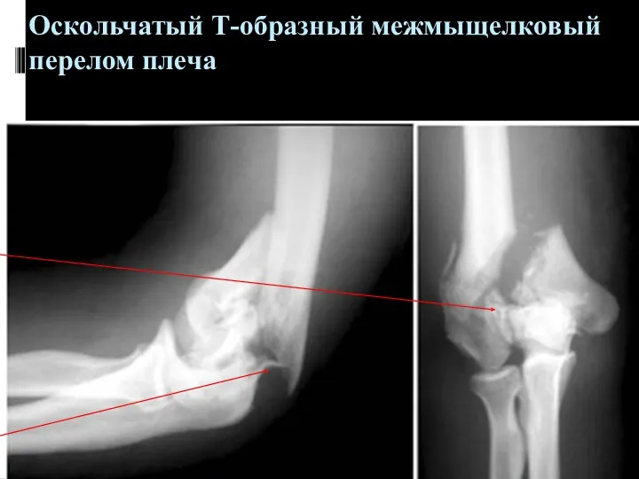 Оскольчатый Т-образный межмыщелковый перелом плеча