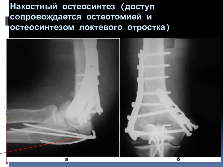 Накостный остеосинтез (доступ сопровождается остеотомией и остеосинтезом локтевого отростка)