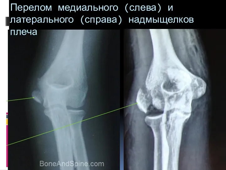 Перелом медиального (слева) и латерального (справа) надмыщелков плеча