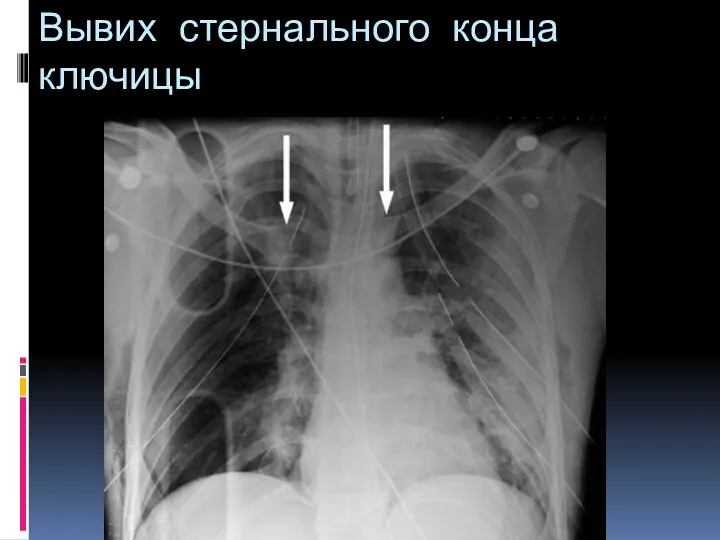 Вывих стернального конца ключицы