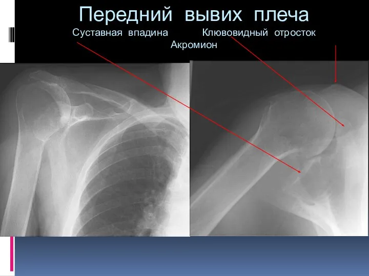 Передний вывих плеча Суставная впадина Клювовидный отросток Акромион