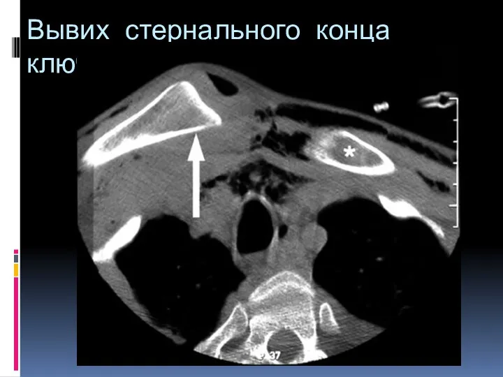 Вывих стернального конца ключицы